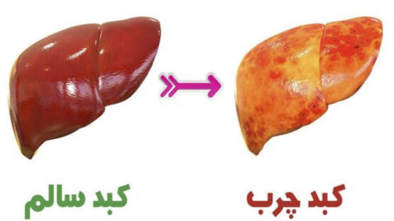 چهارتوصیه برای درمان کبدچرب