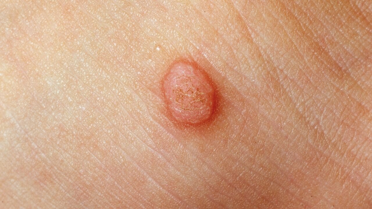 تفاوت خال گوشتی و زگیل چیست؟/ آیا کندن زگیل با ناخنگیر یا بستن نخ خطرناک است؟